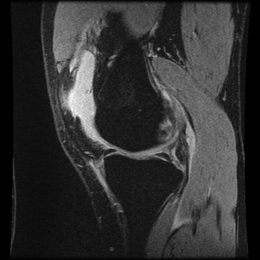 Anterior cruciate ligament tear (Radiopaedia 61500-69462 F 26).jpg