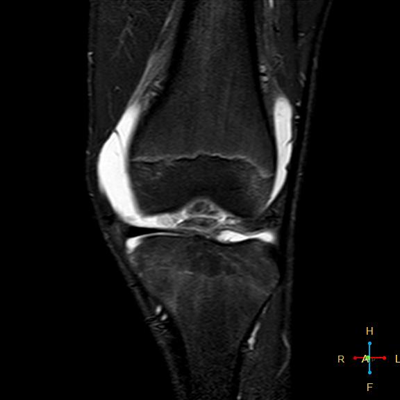 File:Anterior cruciate ligament tear - complete (Radiopaedia 24907-25170 Coronal STIR 7).jpg
