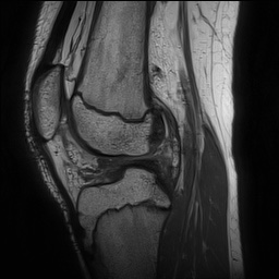 File:Anterior cruciate ligament tear - pediatric (Radiopaedia 62152-70260 Sagittal PD 100).jpg