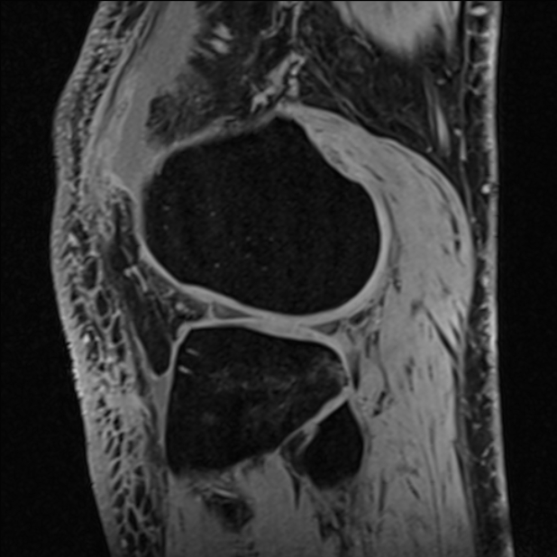 Anterior cruciate ligament tear - ramp lesion (Radiopaedia 71883-82322 Sagittal T1 vibe 39).jpg