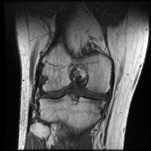 File:Anterior cruciate ligament tear with posteromedial corner injury, bucket-handle meniscal tear and chondral delamination (Radiopaedia 75501-86744 Coronal T1 17).jpg