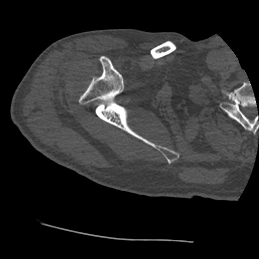 File:Anterior glenohumeral dislocation with Hill-Sachs lesion (Radiopaedia 62877-71249 Axial bone window 26).jpg