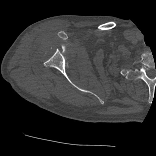 Anterior glenohumeral dislocation with Hill-Sachs lesion (Radiopaedia 62877-71249 Axial bone window 32).jpg