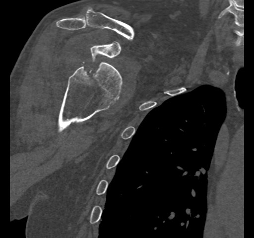 Anterior glenohumeral dislocation with Hill-Sachs lesion (Radiopaedia 62877-71249 Coronal bone window 35).jpg