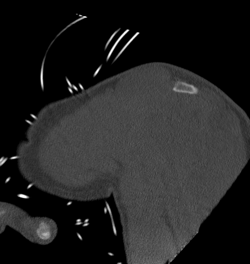 Anterior shoulder dislocation with Hill-Sachs and bony Bankart lesions (Radiopaedia 40424-42974 Sagittal bone window 13).png
