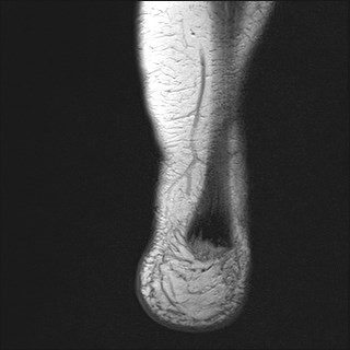 File:Anterior talofibular ligament injury - rupture with soft-tissue impingement (Radiopaedia 38765-40928 Coronal PD 1).jpg