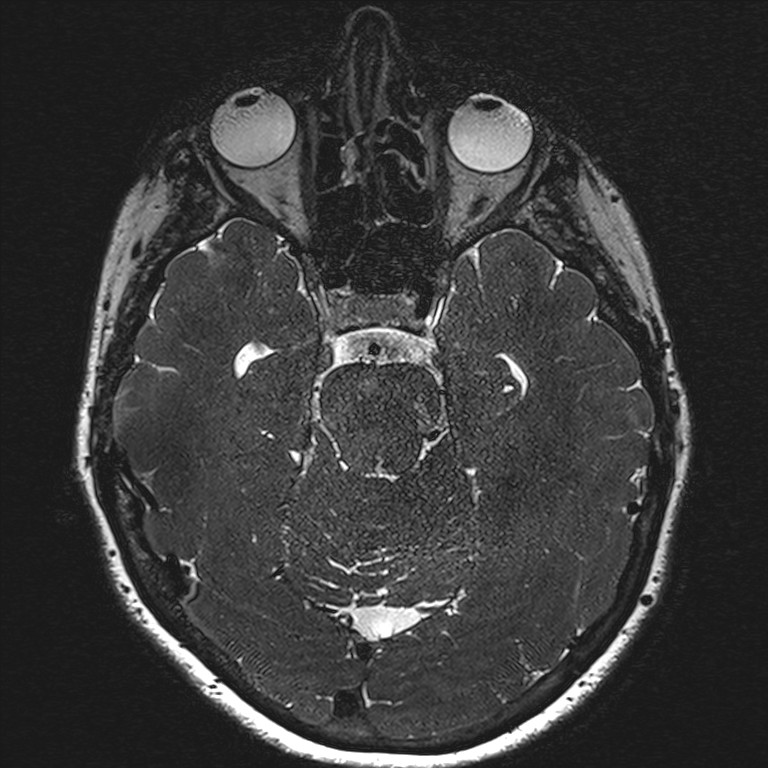 Anterior temporal encephalocele (Radiopaedia 82624-96808 Axial T2 high res 71).jpg