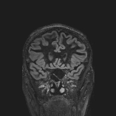 Anterior temporal encephalocele (Radiopaedia 82624-96808 Coronal FLAIR 15).jpg