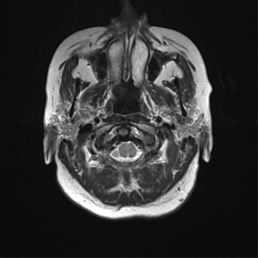 File:Anterior temporal lobe perivascular space (Radiopaedia 40946-43650 Axial T2 2).png