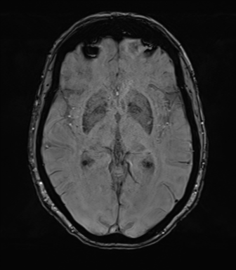 Anterior temporal pole cysts (Radiopaedia 46629-51102 Axial SWI 43).png