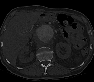 File:Anterior vertebral scalloping (abdominal aortic aneurysm) (Radiopaedia 66744-76067 Axial bone window 32).jpg