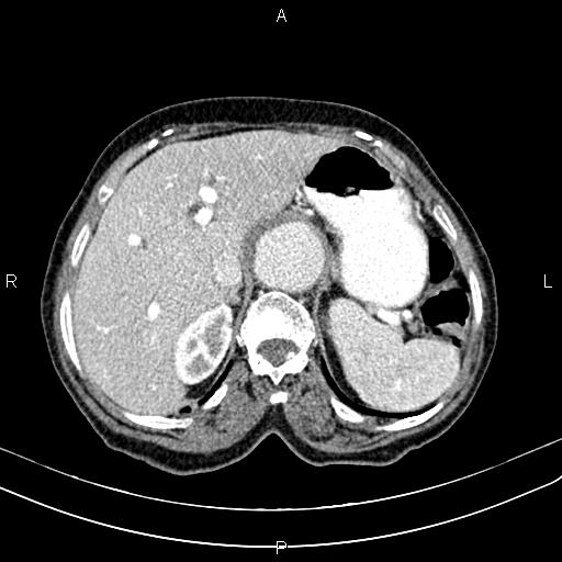 File:Aortic aneurysm and Lemmel syndrome (Radiopaedia 86499-102554 A 21).jpg