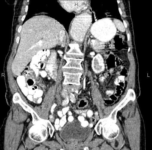 Aortic aneurysm and Lemmel syndrome (Radiopaedia 86499-102554 C 31).jpg