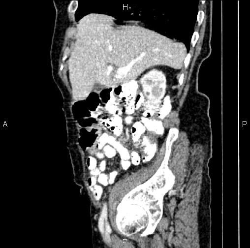 File:Aortic aneurysm and Lemmel syndrome (Radiopaedia 86499-102554 D 20).jpg