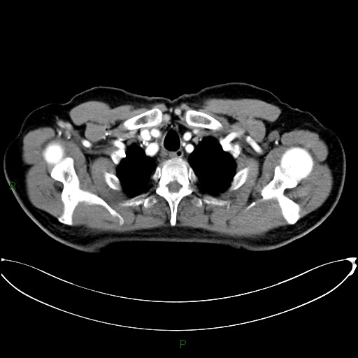Aortic arch origin of left vertebral artery (Radiopaedia 46327-50737 Axial post contrast 15).jpg