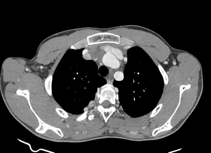 File:Aortic coarctation with aneurysm (Radiopaedia 74818-85828 A 157).jpg