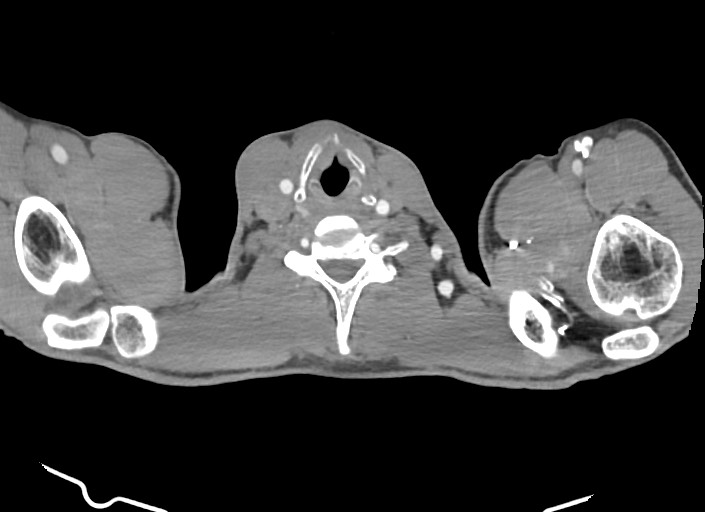 File:Aortic coarctation with aneurysm (Radiopaedia 74818-85828 A 198).jpg