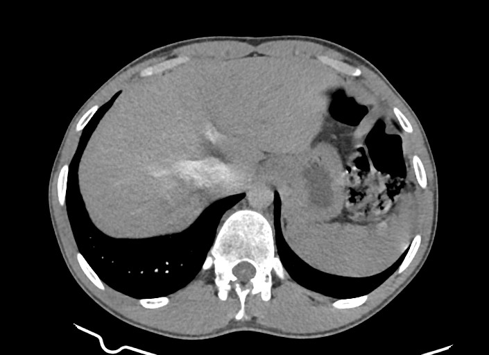 File:Aortic coarctation with aneurysm (Radiopaedia 74818-85828 A 42).jpg