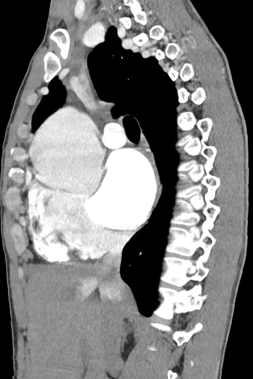 Aortic coarctation with aneurysm (Radiopaedia 74818-85828 B 71).jpg