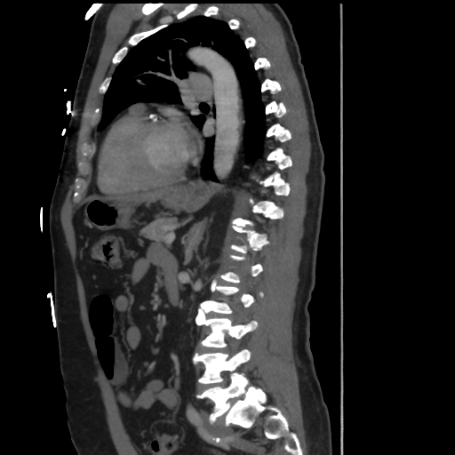 File:Aortic dissection- Stanford A (Radiopaedia 37759-39664 Sagittal C+ delayed 25).png