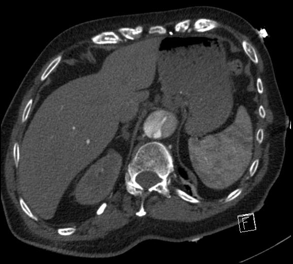 Aortic dissection (CTPA) (Radiopaedia 75506-86750 A 84).jpg
