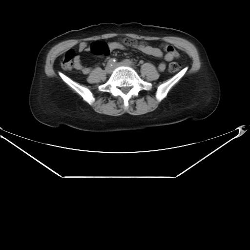 File:Aortic dissection (Radiopaedia 25350-25604 B 57).jpg