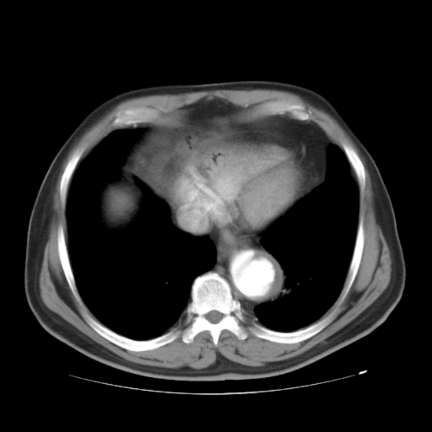 Aortic dissection (Radiopaedia 44411-48061 C 20).jpg
