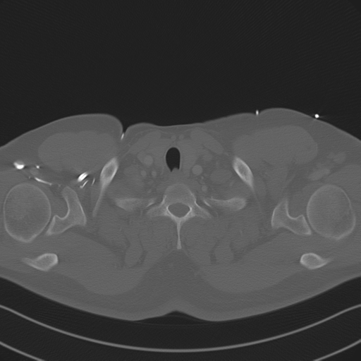 Aortic dissection (Radiopaedia 50763-56234 Axial bone window 11).png