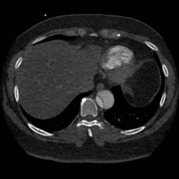File:Aortic dissection (Radiopaedia 57969-64959 A 242).jpg