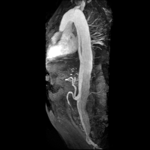 File:Aortic dissection - Stanford A - DeBakey I (Radiopaedia 23469-23551 MRA 18).jpg