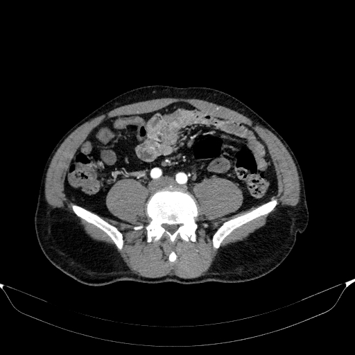 Aortic dissection - Stanford type A (Radiopaedia 83418-98500 A 93).jpg