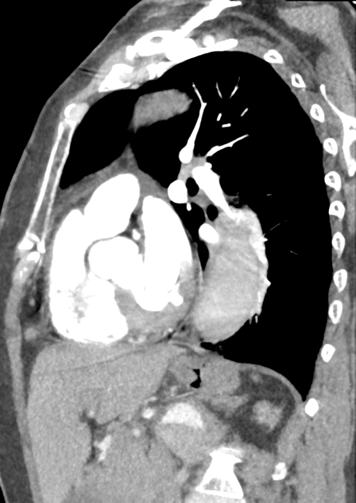 Aortic dissection - Stanford type B (Radiopaedia 50171-55512 C 20).png