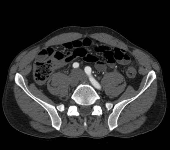 Aortic dissection - Stanford type B (Radiopaedia 73648-84437 A 206).jpg