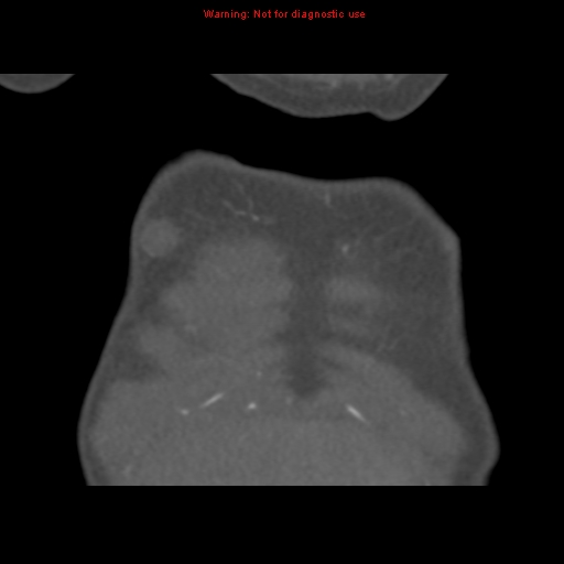 File:Aortic ductus diverticulum (Radiopaedia 8339-9180 B 7).jpg