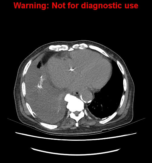 Aortic graft infection (Radiopaedia 44979-48907 Axial non-contrast 12).jpg