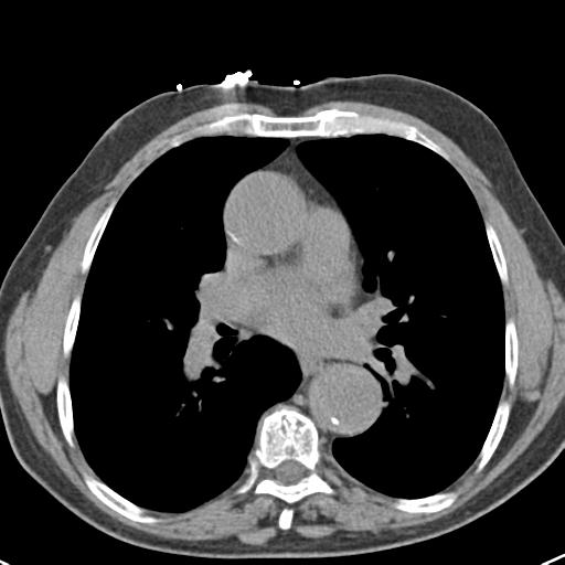 Aortic intramural hematoma (Radiopaedia 31139-31838 Axial non-contrast 29).jpg