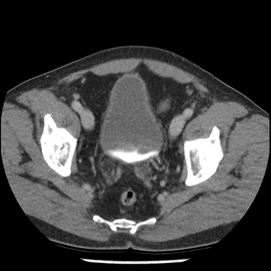 Aortic intramural hematoma (type B) (Radiopaedia 79323-92387 Axial C+ delayed 105).jpg