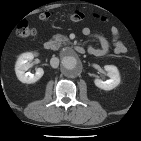 Aortic intramural hematoma (type B) (Radiopaedia 79323-92387 Axial C+ delayed 68).jpg