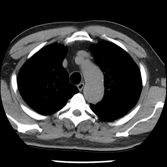 Aortic intramural hematoma (type B) (Radiopaedia 79323-92387 Axial non-contrast 11).jpg