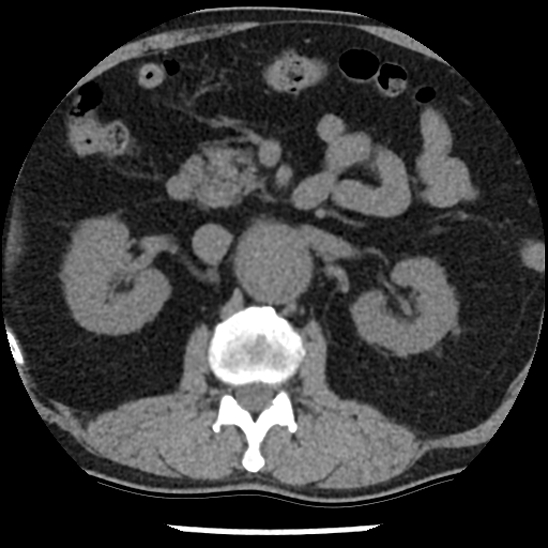 Aortic intramural hematoma (type B) (Radiopaedia 79323-92387 Axial non-contrast 65).jpg