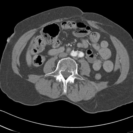 Aortic intramural hematoma from penetrating atherosclerotic ulcer (Radiopaedia 31137-31836 A 119).jpg