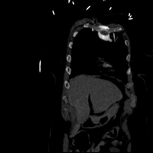 File:Aortic intramural hematoma from penetrating atherosclerotic ulcer (Radiopaedia 31137-31836 C 9).jpg