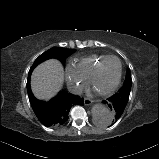 File:Aortic intramural hematoma with dissection and intramural blood pool (Radiopaedia 77373-89491 Axial non-contrast 69).jpg