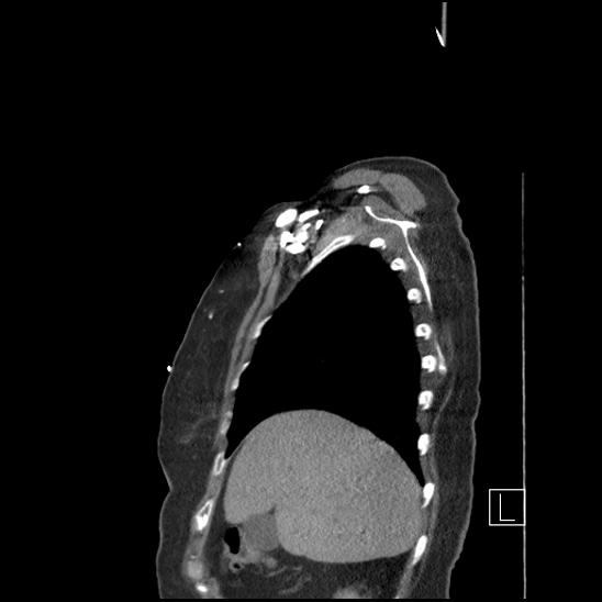 Aortic intramural hematoma with dissection and intramural blood pool (Radiopaedia 77373-89491 D 13).jpg