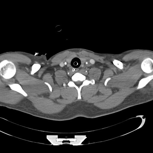 Aortic transection, diaphragmatic rupture and hemoperitoneum in a complex multitrauma patient (Radiopaedia 31701-32622 A 2).jpg