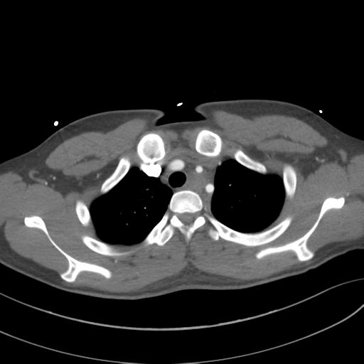 File:Aortic transection (Radiopaedia 29890-30405 A 23).jpg