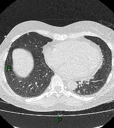 File:Aortic valve endocarditis (Radiopaedia 87209-103485 Axial lung window 68).jpg