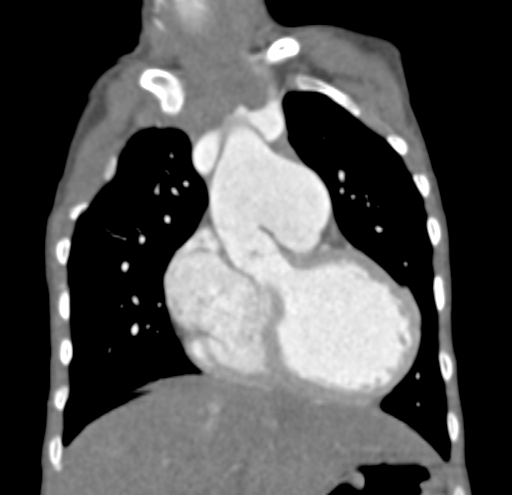 File:Aortopulmonary window, interrupted aortic arch and large PDA giving the descending aorta (Radiopaedia 35573-37074 D 21).jpg