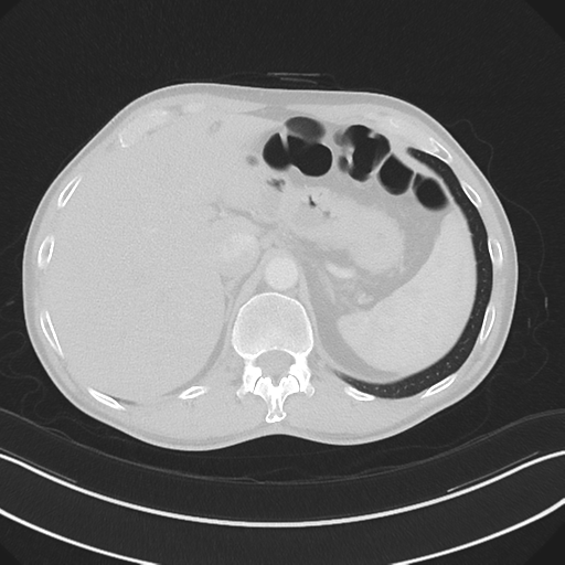 Apical pleural calcification (Radiopaedia 46141-50499 Axial lung window 68).png