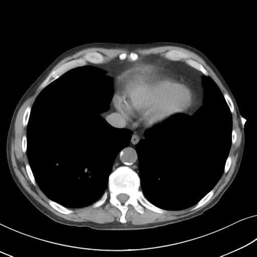 Apical pulmonary metastasis (Radiopaedia 46338-50754 B 49).png